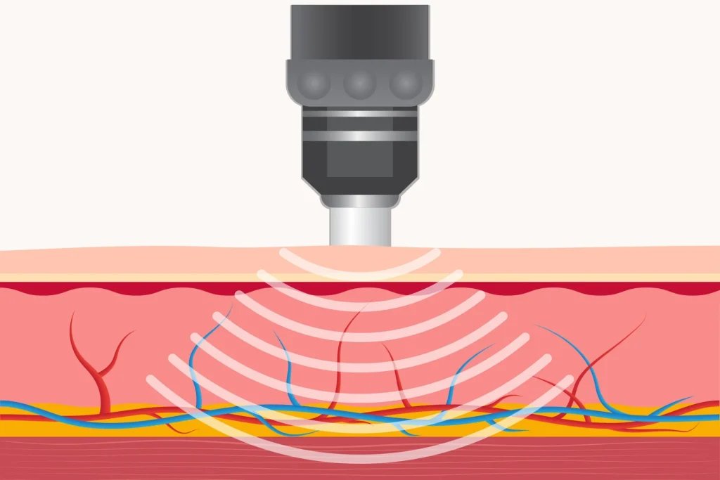 A Pulse Wave (EPAT) handpiece in use over the heel during a session in Allentown