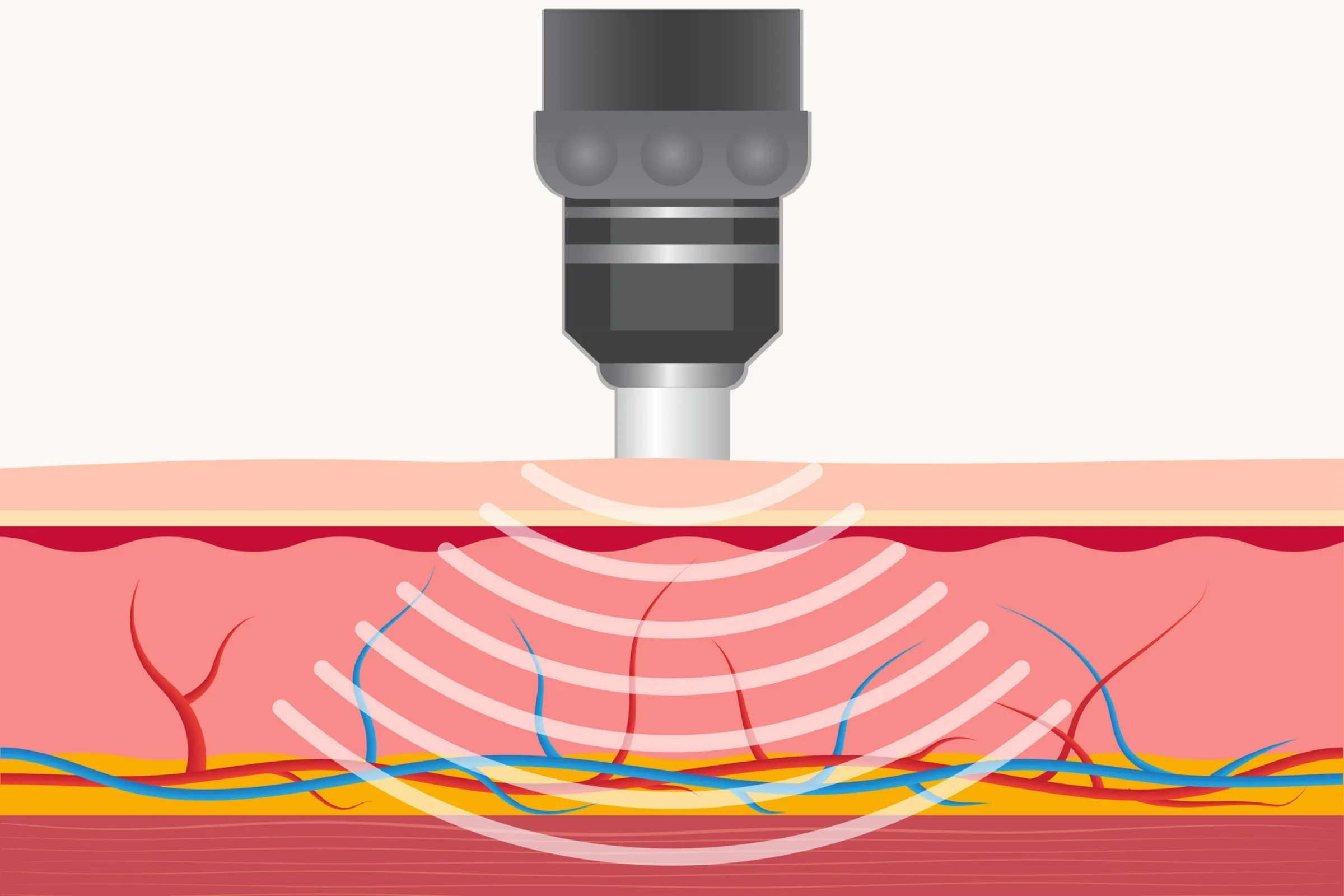 Pulse Wave (EPAT) in Allentown